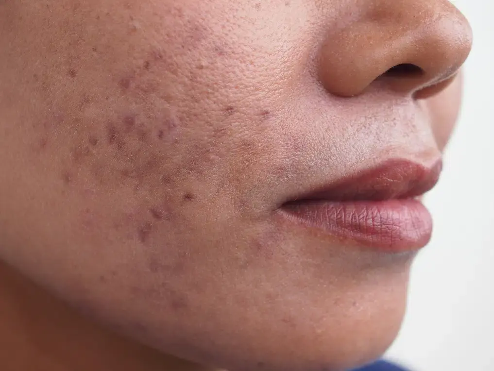 Hyperpigmentation